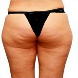 PEAU D'ORANGE & CELLULITE - CONSEILS UTILES